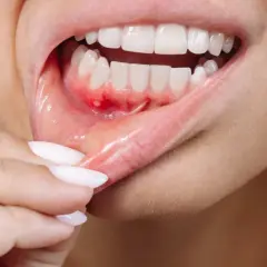 Detalle de una boca con úlceras y enrojecimiento, mostrando posibles causas de boca irritada por dentro.