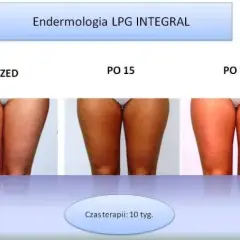 Ile zabiegów endermologii? Od 10 do 20 sesji poznaj plan!