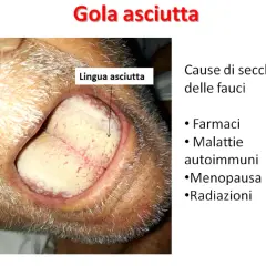 Lingua secca e pallida, sintomo di gola asciutta. Cause: farmaci, malattie autoimmuni, menopausa, radiazioni.