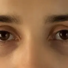 Augenringe mangel an Schlaf. Dunkle Schatten unter den Augen deuten auf Müdigkeit hin.