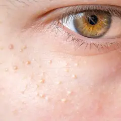 Nahaufnahme der Haut neben einem Auge mit vielen kleinen, hellen Erhebungen. Diese Hautunreinheiten sind nicht komedogen und stören die natürliche Ausstrahlung nicht.