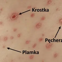 Skóra z licznymi zmianami: plamkami, krostkami i pęcherzykami. To po dniu ospa początki.