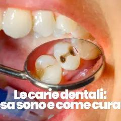 Denti con evidenti carie visibili nello specchietto del dentista.