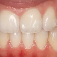 Dientes alineados y sanos, resultado de un tratamiento de ortodoncia invisible, **invisalign sin ataches**.