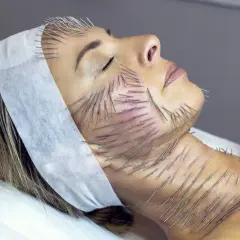 Kobieta poddana zabiegowi akupunktury twarzy i szyi. Liczne igły wbijane są w skórę, co jest częścią terapii needle shaping.