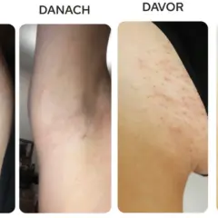 Vorher/Nachher-Bilder zeigen Achseln mit Rötungen und Pickeln nach der Rasur. Nach der Anwendung von Tipps zur Rasur sind die Achseln glatter und reizfreier.