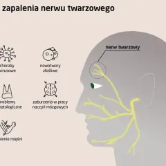 Ilustracja przedstawia przyczyny zapalenia nerwu twarzowego: wirusy, nowotwory, problemy stomatologiczne, zaburzenia naczyń mózgowych i zapalenie mięśni.