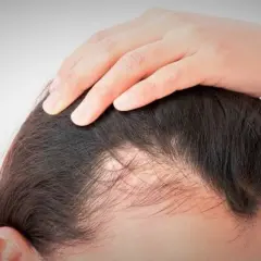 Mano tocando el cuero cabelludo con zonas de cabello escaso. ¿Qué vitamina me falta si se me cae el pelo?