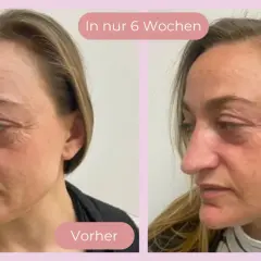 Vorher-Nachher-Vergleich: Hautbild einer Frau vor und nach 6 Wochen Behandlung. Deutliche Reduzierung von Falten, die Haut wirkt straffer. Kollagen-Effekt sichtbar.