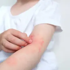 Dziecko drapie zaczerwienioną skórę na ramieniu, objawy alergii.