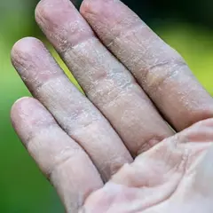 Dedos con piel seca y agrietada, síntoma de dishidrosis.