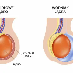 Porównanie prawidłowego jądra z jądrem dotkniętym wodniakiem. Wodniak jądra to nagromadzenie płynu.