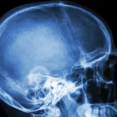 Rentgen czaszki z profilu. Widoczne struktury kostne głowy, w tym jama czaszki, kości twarzy i szczęka. Może to być pomocne w diagnostyce schorzeń wpływających na nerw błędny.