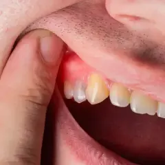 Co wyciąga ropę z zęba? Tylko dentysta! Ulga i ratunek
