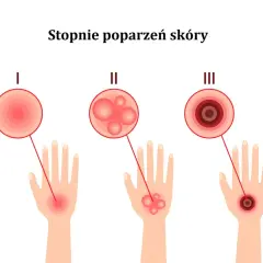 Ilustracja pokazuje stopnie poparzeń skóry: I stopień to zaczerwienienie, II stopień to bąble po oparzeniu słonecznym, a III stopień to głębokie uszkodzenie.