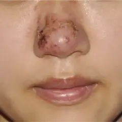 Biofilm po kwasie hialuronowym objawy: jak uniknąć powikłań?