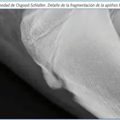 Radiografía de rodilla que muestra fragmentación de la apófisis tibial derecha, indicativo de Osgood-Schlatter.