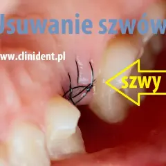 Ile kosztuje zdjęcie szwów u dentysty? Ceny, które zaskoczą!