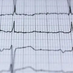 EKG z migotaniem przedsionków. Czy to powód do obaw przed wyrwaniem zęba? Analiza rytmu serca.