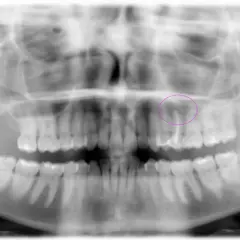 Radiografía panorámica dental que muestra la necesidad de una exodoncia quirúrgica de un diente superior, resaltado en círculo.