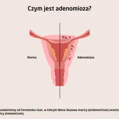 Ilustracja porównuje zdrową macicę z macicą z **adenomiozą**, gdzie tkanka endometrium wrasta w mięsień macicy.