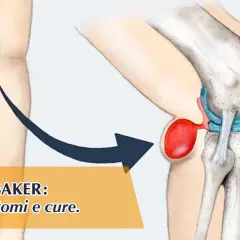 Illustrazione anatomica del ginocchio che mostra una cisti di Baker. Scopri come sfiammare cisti di Baker, cause, sintomi e cure.