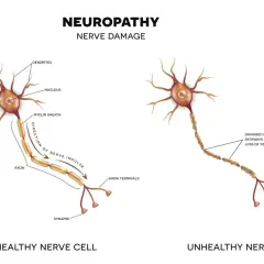 Ilustracja porównuje zdrową i uszkodzoną komórkę nerwową, wyjaśniając, co to jest neuropatia – uszkodzenie nerwów prowadzące do utraty czucia.