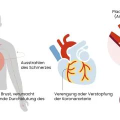 Brustschmerzen, die in Arme ausstrahlen, sind ein Symptom von Angina Pectoris, verursacht durch verengte Koronararterien und verringerten Blutfluss zum Herzen.