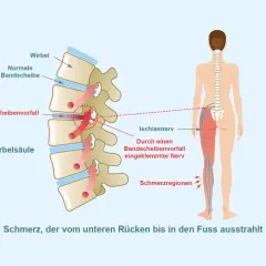 Bandscheibenvorfall klemmt Ischiasnerv ein, verursacht Schmerz vom Rücken bis zum Fuß. Was hilft sofort bei Ischias?