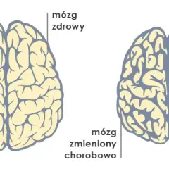 Demencja to choroba mózgu, nie psychiczna. Wyjaśniamy różnice.