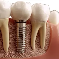 Dettaglio di un impianto dentale in titanio, parte di un processo di implantologia a carico immediato, che sostituisce una radice dentale.