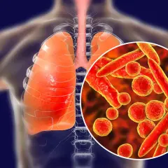 Płuca i tchawica człowieka z powiększoną wizualizacją bakterii Mycoplasma pneumoniae, które mogą wywoływać zapalenie płuc i inne objawy.