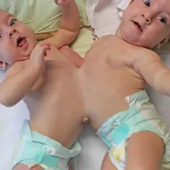 Zwei niedliche siamesische Zwillinge liegen nebeneinander. Sie tragen Windeln und blicken neugierig in die Kamera.