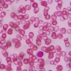 Widoczne liczne czerwone krwinki o zróżnicowanych kształtach i rozmiarach, co wskazuje na anizocytozę erytrocytów. W centrum obrazu pojedynczy, fioletowy leukocyt.