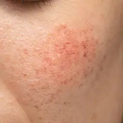 Gros plan sur une joue présentant des rougeurs diffuses, des télangiectasies et des petites pustules, symptômes typiques de la rosacée pustuleuse.