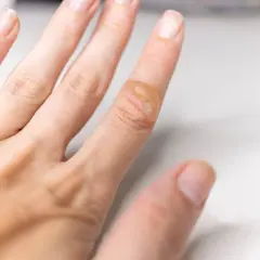 Gros plan sur une cloque de brûlure sur un doigt, suggérant des méthodes pour comment soigner une cloque de brûlure naturellement.