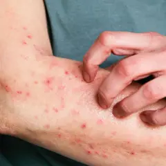 Ręka drapiąca skórę z czerwonymi krostkami i plamkami. Czy to dermatoza, co to za schorzenie?