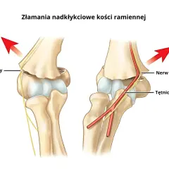 Złamania nadkłykciowe kości ramiennej po upadku. Widoczne uszkodzenie nerwu łokciowego i naczynia krwionośne.