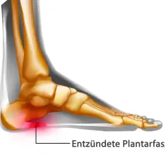 Entzündete Plantarfaszie im Fuß, die Schmerzen verursacht. Die Plantarfasziitis wird immer schlimmer.