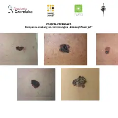 Różne rodzaje znamion i czerniaków. Kampania edukacyjna "Znamię! Znam je?".