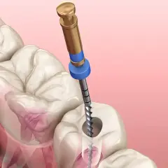 Ząb z ropą wymaga leczenia kanałowego. Narzędzie dentystyczne czyści kanał korzeniowy.
