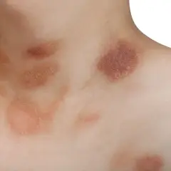 Macchie cutanee sul collo e petto, possibili manifestazioni di pitiriasi rosea di Gibert, a volte associate a stress.
