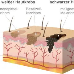 Vergleich von weißem Hautkrebs (Plattenepithelkarzinom, Basalzellkarzinom) und schwarzem Hautkrebs (malignes Melanom). Welcher Hautkrebs ist schlimmer? Das Melanom ist aggressiver.