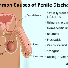 Diagrama anatómico del sistema reproductor masculino con etiquetas y lista de causas de secreción peniana.