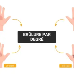Illustration montrant l'évolution des brûlures de 1er degré à 4e degré sur une main. Le traitement d'une brûlure premier degré est le plus simple.