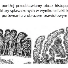 Celiakia jaki lekarz - jak nie popełnić błędu w diagnozie?