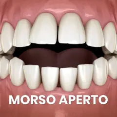 Denti bianchi e gengive rosa, con la scritta "MORSO APERTO". La lingua morsicata è visibile tra gli incisivi inferiori.