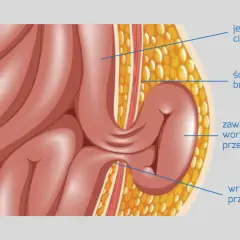 Ilustracja przedstawia przepuklinę pachwinową u mężczyzn, pokazując jelito cienkie przechodzące przez ścianę jamy brzusznej.