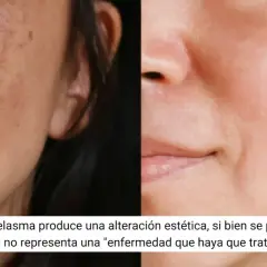 Comparación de piel con melasma y piel tratada. El ácido tranexámico para qué sirve: mejora manchas y unifica el tono.