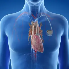 Anatomical illustration of a human heart with a pacemaker. Warto wiedzieć, ile się czeka na wszczepienie rozrusznika serca.
